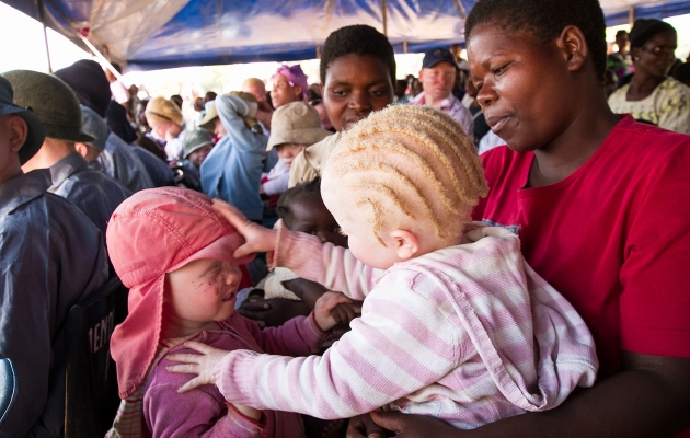 Albinoer er stærkt udsatte i Swaziland. Foto: Scanpix